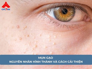 Mụn gạo: Nguyên nhân hình thành và cách cải thiện