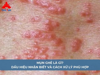 Mụn ghẻ là gì? Dấu hiệu nhận biết và cách xử lý phù hợp