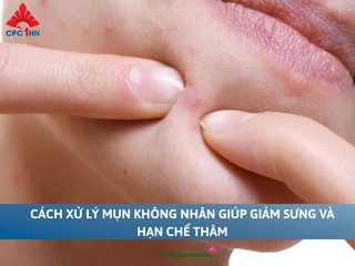Cách xử lý mụn không nhân giúp giảm sưng và hạn chế thâm