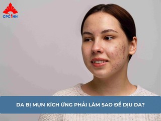 Da bị mụn kích ứng phải làm sao để dịu da?
