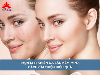 Mụn li ti khiến da sần kém mịn? Cách cải thiện hiệu quả