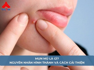 Mụn mủ là gì? Nguyên nhân hình thành và cách cải thiện
