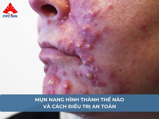 Mụn nang hình thành thế nào và cách điều trị an toàn