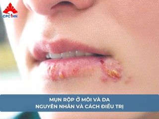 Mụn rộp ở môi và da: Nguyên nhân và cách điều trị