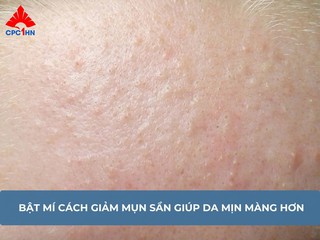 Bật mí cách giảm mụn sần giúp da mịn màng hơn