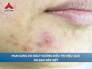 Mụn sưng do đâu? Hướng điều trị hiệu quả mà bạn nên biết