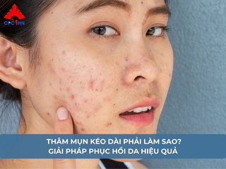 Thâm mụn kéo dài phải làm sao? Giải pháp phục hồi da hiệu quả