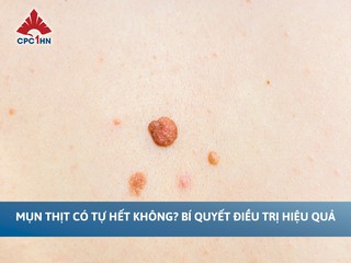 Mụn thịt có tự hết không? Bí quyết điều trị hiệu quả