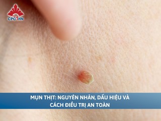 Mụn thịt: Nguyên nhân, dấu hiệu và cách điều trị an toàn