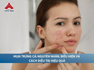 Mụn trứng cá: Nguyên nhân, biểu hiện và cách điều trị hiệu quả