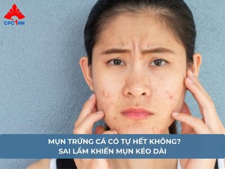 Mụn trứng cá có tự hết không? Sai lầm khiến mụn kéo dài