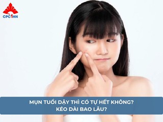 Mụn tuổi dậy thì có tự hết không? Kéo dài bao lâu?