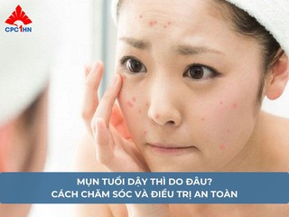 Mụn tuổi dậy thì do đâu? Cách chăm sóc và điều trị an toàn