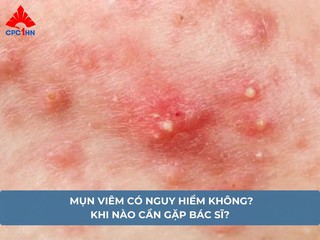 Mụn viêm có nguy hiểm không? Khi nào cần gặp bác sĩ?