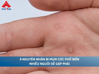 8 nguyên nhân bị mụn cóc phổ biến nhiều người dễ gặp phải