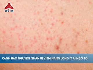 Cảnh báo nguyên nhân bị viêm nang lông ít ai ngờ tới