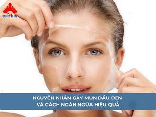 Nguyên nhân gây mụn đầu đen và cách ngăn ngừa hiệu quả