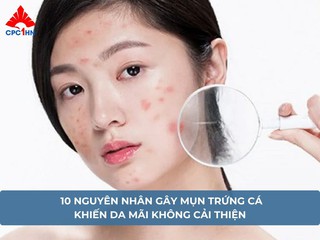 10 nguyên nhân gây mụn trứng cá khiến da mãi không cải thiện