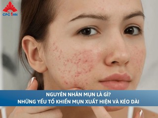 Nguyên nhân mụn là gì? Những yếu tố khiến mụn xuất hiện