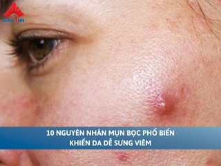 10 nguyên nhân mụn bọc phổ biến khiến da dễ sưng viêm