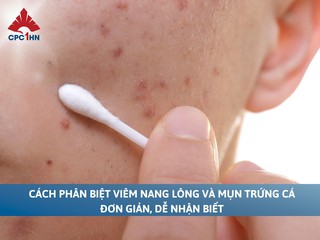 Cách phân biệt viêm nang lông và mụn trứng cá đơn giản, dễ nhận biết 