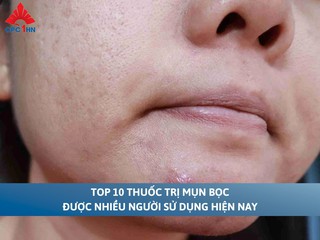 Top 10 thuốc trị mụn bọc được nhiều người sử dụng hiện nay