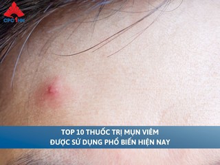 Top 10 thuốc trị mụn viêm được sử dụng phổ biến hiện nay 