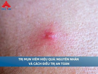 Trị mụn viêm hiệu quả: Nguyên nhân và cách điều trị an toàn