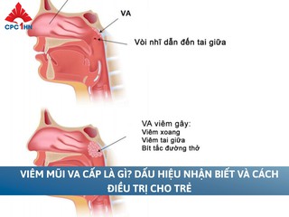 Viêm mũi VA cấp là gì? Dấu hiệu nhận biết và cách điều trị