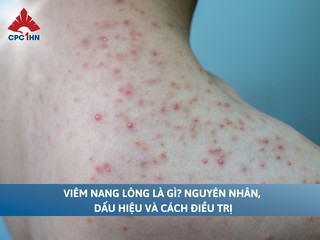 Viêm nang lông là gì? Nguyên nhân, dấu hiệu và cách điều trị