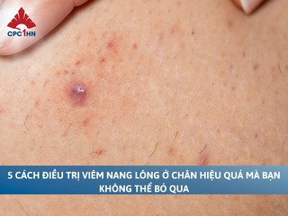5 cách điều trị viêm nang lông ở chân hiệu quả không thể bỏ qua