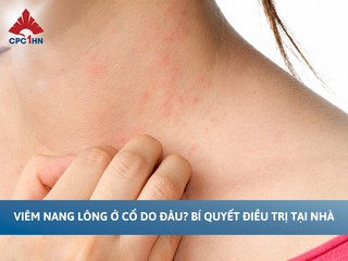 Viêm nang lông ở cổ do đâu? Bí quyết điều trị tại nhà