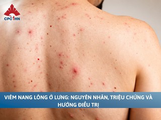 Viêm nang lông ở lưng: Nguyên nhân, triệu chứng và hướng điều trị