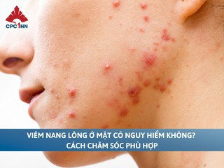 Viêm nang lông ở mặt có nguy hiểm không? Cách chăm sóc phù hợp