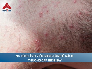 20+ hình ảnh viêm nang lông ở nách thường gặp hiện nay