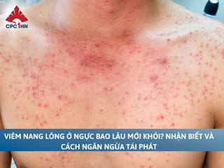 Viêm nang lông ở ngực bao lâu mới khỏi? Cách ngăn ngừa tái phát