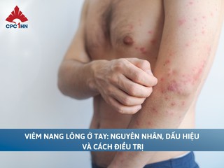 Viêm nang lông ở tay: Nguyên nhân, dấu hiệu và cách điều trị