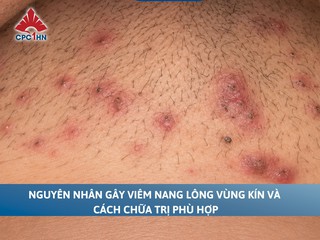 Nguyên nhân gây viêm nang lông vùng kín và cách chữa trị phù hợp
